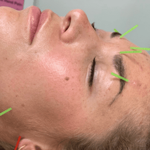 Kosmetisk akupunktur